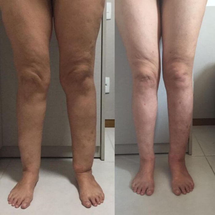 lipedema-antes-e-depois01