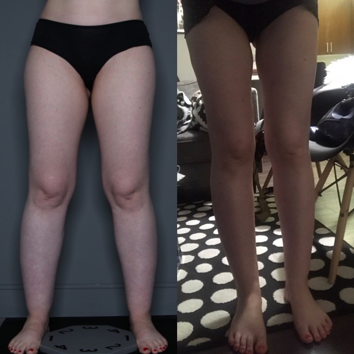 lipedema-antes-e-depois02