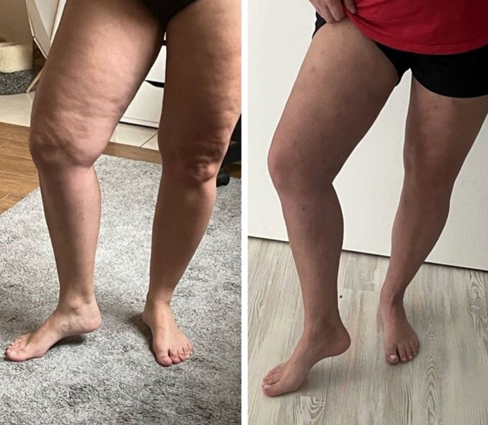 lipedema-antes-e-depois07