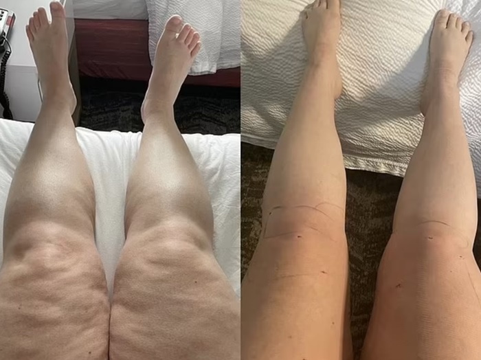 lipedema-antes-e-depois10