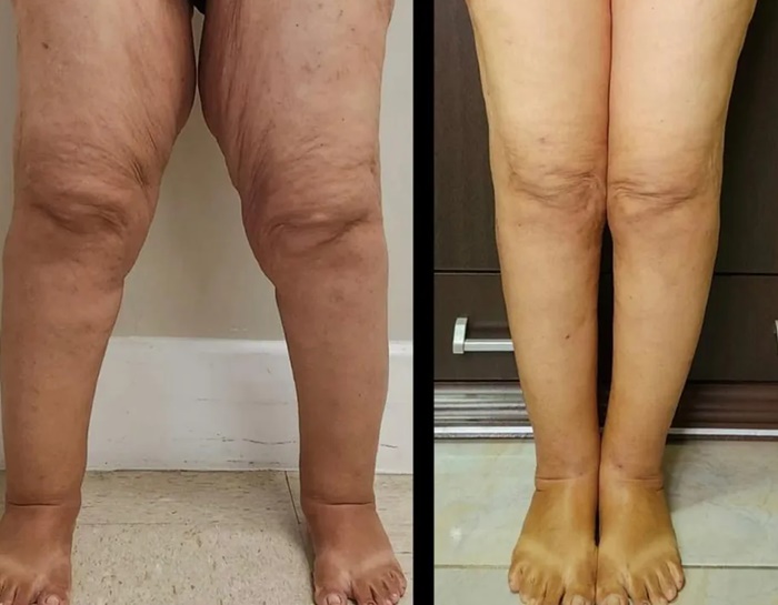 lipedema-antes-e-depois13