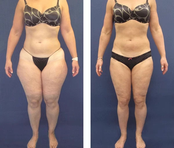 lipedema-antes-e-depois20
